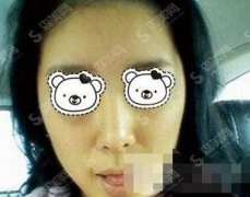 上海华美整形美容医院价目表2021，做黑脸娃娃多少钱，内含黑脸娃娃案例果对比图