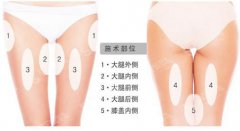 大腿抽脂的价格？附大腿抽脂案例+前后果对比图