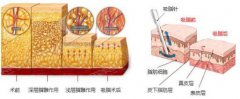 吸脂手术的价格？附吸脂手术案例+前后果对比图