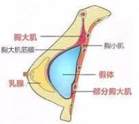 假体隆胸的价格？附假体隆胸案例+整形前后对比图