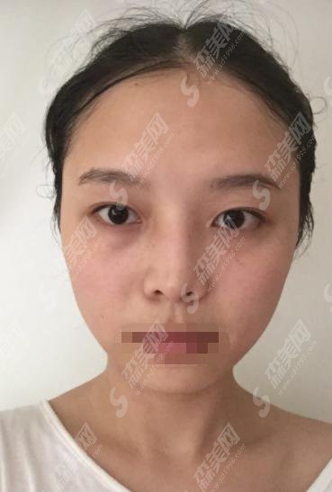 齐鲁医院美容科靠谱吗？齐鲁医院美容科做的双眼皮果好不好？附医生介绍及案例分享