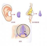 自体软骨隆鼻手术的价格？附隆鼻耳软骨手术案例+前后果对比图