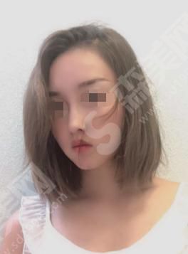 美莱和华美哪个好?做的隆鼻怎么样？附医院介绍及医师介绍