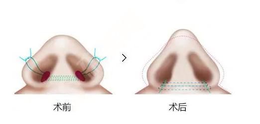 鼻翼缩小是什么？鼻翼缩小的果怎么样？附鼻翼缩小的价格以及案例