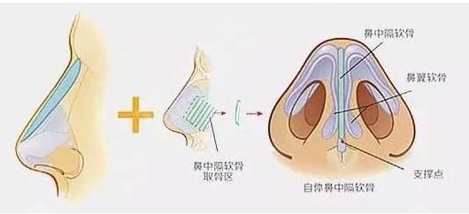 鼻小柱延长的原理,鼻小柱的果如何？附注意事项以及案例分享