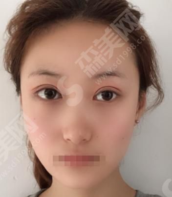 天津伊美尔怎么样？天津伊美尔做的双眼皮果如何？附医师介绍及案例分享