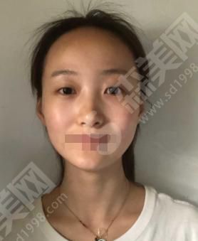 天津伊美尔怎么样？天津伊美尔做的双眼皮果如何？附医师介绍及案例分享