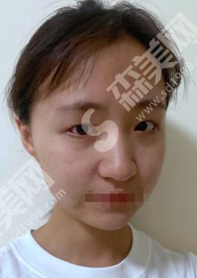 扬州苏北人民医院整形医院做的双眼皮果如何？附医师介绍及案例分享