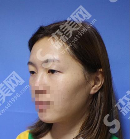 合肥壹加壹美容整形医院正规吗？附案例分享