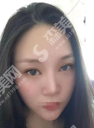 沈阳陆军总院整形科的整形果如何？附真人案例分享