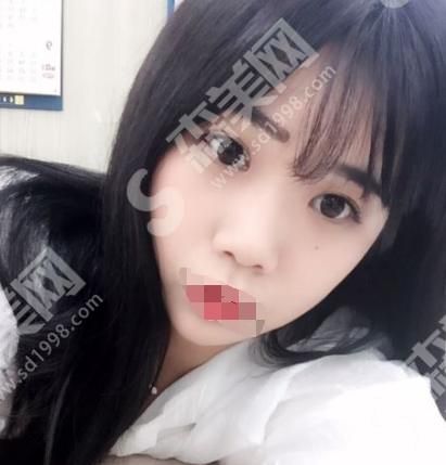 西安画美医疗美容医院双眼皮果如何？医院口碑怎么样？附医院介绍医生介绍及案例分享