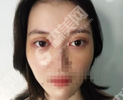 高一生美容医院怎么样？附双眼皮整形果图