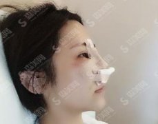 中南大学湘雅医院整形美容科鼻部手术案例分享，你们觉的我的恢复如何，有没有惊呆住！