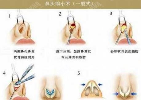 鼻头缩小手术想要果好，这些注意事项要牢记