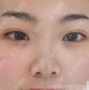 济南省立医院美容科祛斑价格表,祛斑案例及术后果