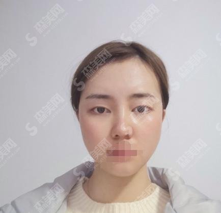郑大五附院整形科双眼皮手术果如何，姜南医生亲自操作实力彰显！