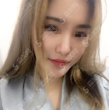 济南中心医院美容科隆鼻经济性价比高吗？真是如此？真人案例为您见证