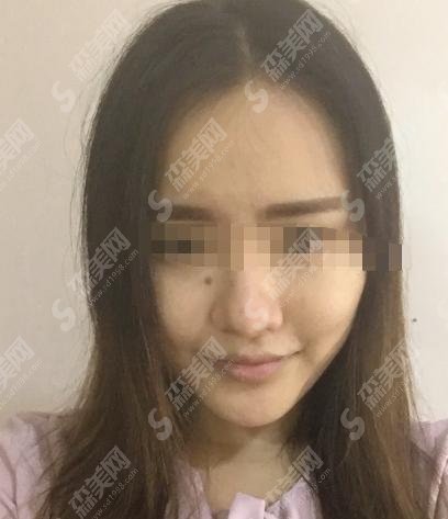 济南中心医院美容科隆鼻经济性价比高吗？真是如此？真人案例为您见证