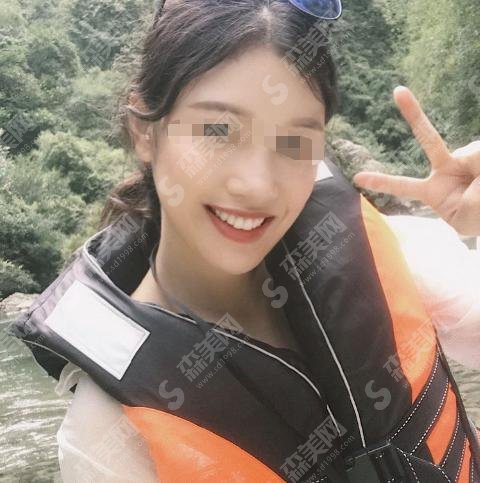 113医院整形美容科隆鼻技术靠谱吗？附医院介绍及隆鼻案例前后对比