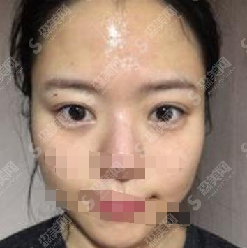 眼部除皱医院果完美的是谁家？北京蜜悦医疗登上榜单！