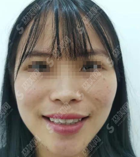 成都华西口腔做的牙齿矫正如何？附整形案例和专家简介