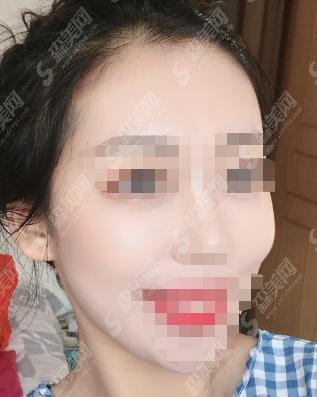 西安美莱整形医生光子嫩肤年轻化如何？真实案例反馈