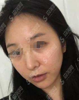 热玛吉和热拉提哪个果好？两者区别是什么？较新资讯等你来看