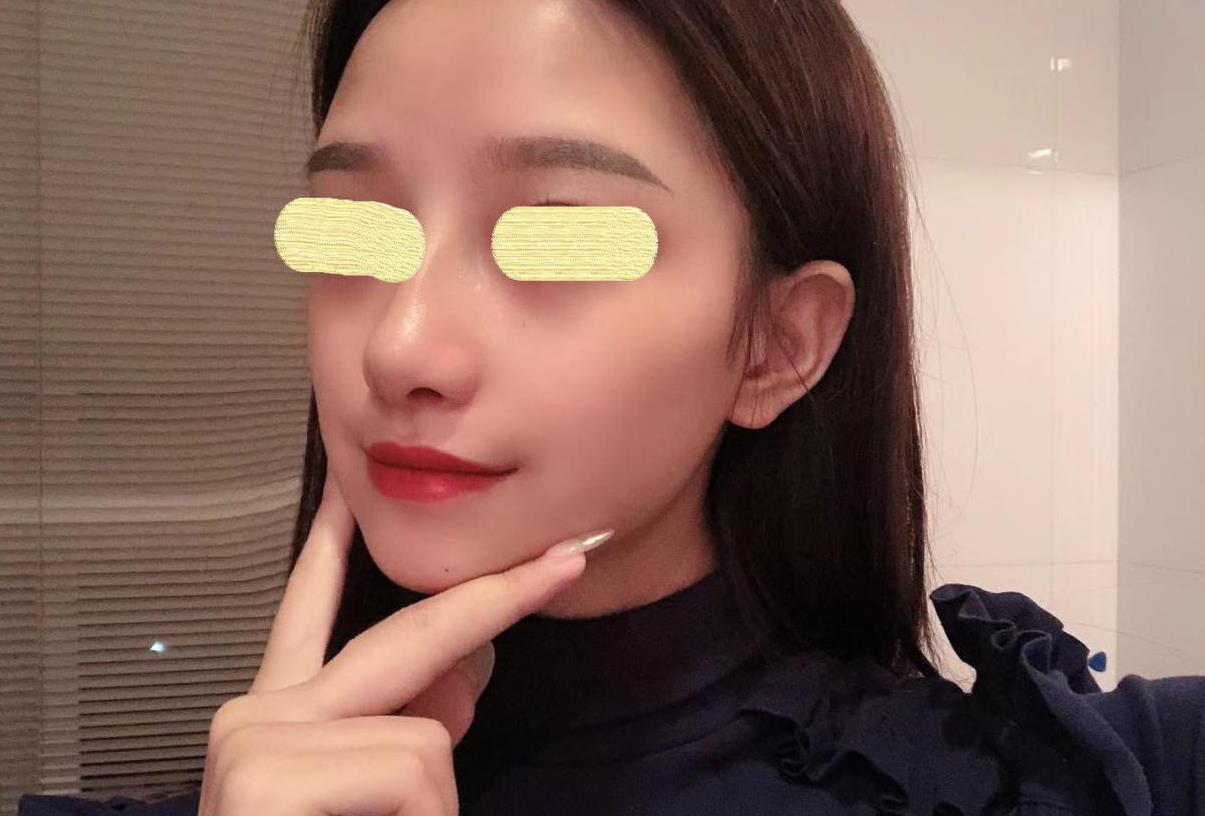 隆鼻术前术后不做好这几件事，极容易导致手术