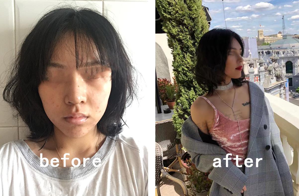 隆鼻术前术后不做好这几件事，极容易导致手术