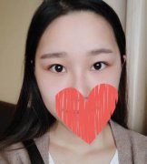 苏州省立医院整形科刘武林双眼皮好不好？真实术后照片分享