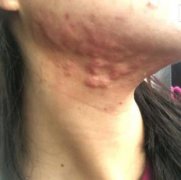 河北省人民医院整形美容科去疤痕果怎样？治疗前后对比照片