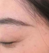 烟台京韩整形美容医院去眼角纹怎么样？真实术后恢复照片