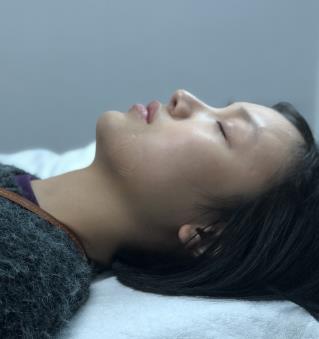 杭州维多利亚整形医院垫下巴果对比图，恢复过程分享