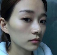 别人忧愁不好割的下颌角，我却使劲浑身解数才想办法把这个给去掉