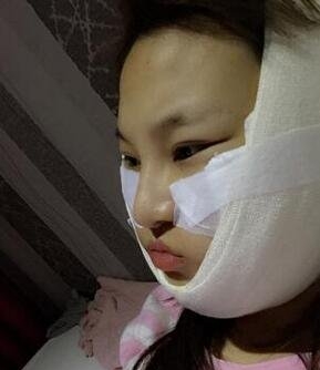 韩国金一秀的磨骨怎么样？项目价格和相关案例展示