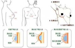 想知道|隆胸的手感和真的一样吗？会不会特别假呀