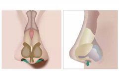 鼻基底攻略|千万别瞎动鼻基底，这几个不同需警醒