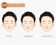 下颌角宽大该怎么改善？费用是多少呢？