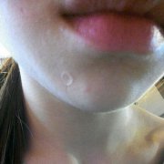 20年的疤在这一天终于可以和它说不见了！