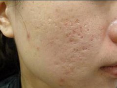 十几年的老痘坑，就这么被治好啦？