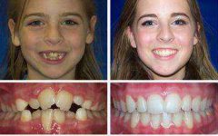 很漂亮|这例属于轻度的牙齿不齐的矫正案例，出自于广州口腔之手