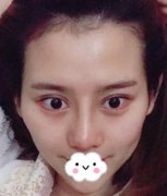 泉州美女在成都罗通贵那面部凹陷填充 减龄十岁