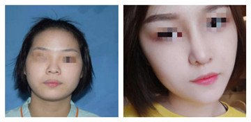 尹慧珍医生技术怎么样?贵不贵?个人主页和案例展示