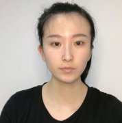 attention！真人出镜的韩式隆鼻前后比较图，不说肯定以为是两个人