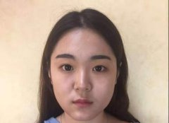 成都美未央的双眼皮 这个恢复果真真很自然啦