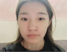 东方和谐二次填充技术如何，亲身体验面部脂肪填充案例分享