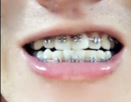 在成都华西口腔医院做的牙齿矫正果超赞，让三十岁的我中午敢笑了