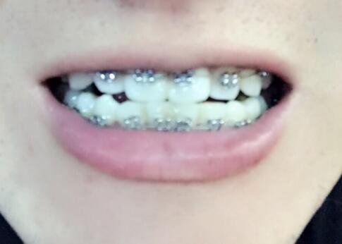 在成都华西口腔医院做的牙齿矫正果超赞，让三十岁的我中午敢笑了