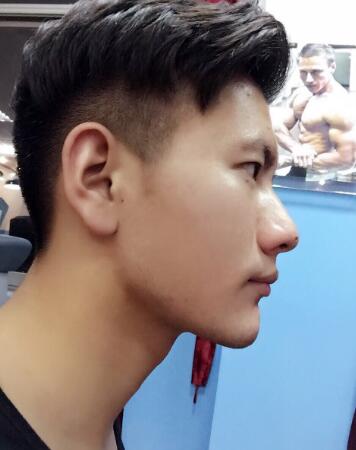 在成都华西口腔医院做的牙齿矫正果超赞，让三十岁的我中午敢笑了