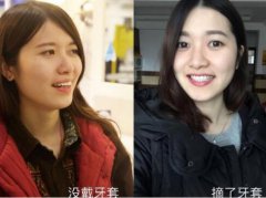 在大连口腔医院做的矫正已经有两年的时间了